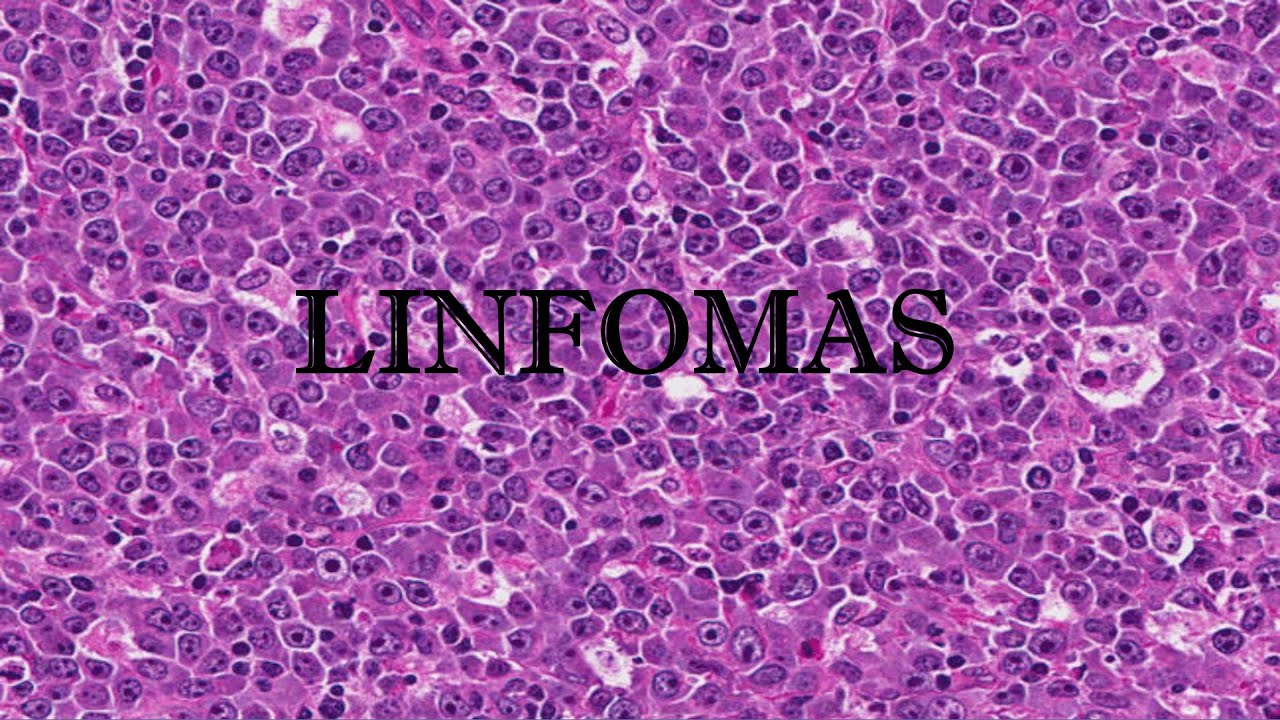 LINFOMA FISIOPATOLOGÍA - YouTube