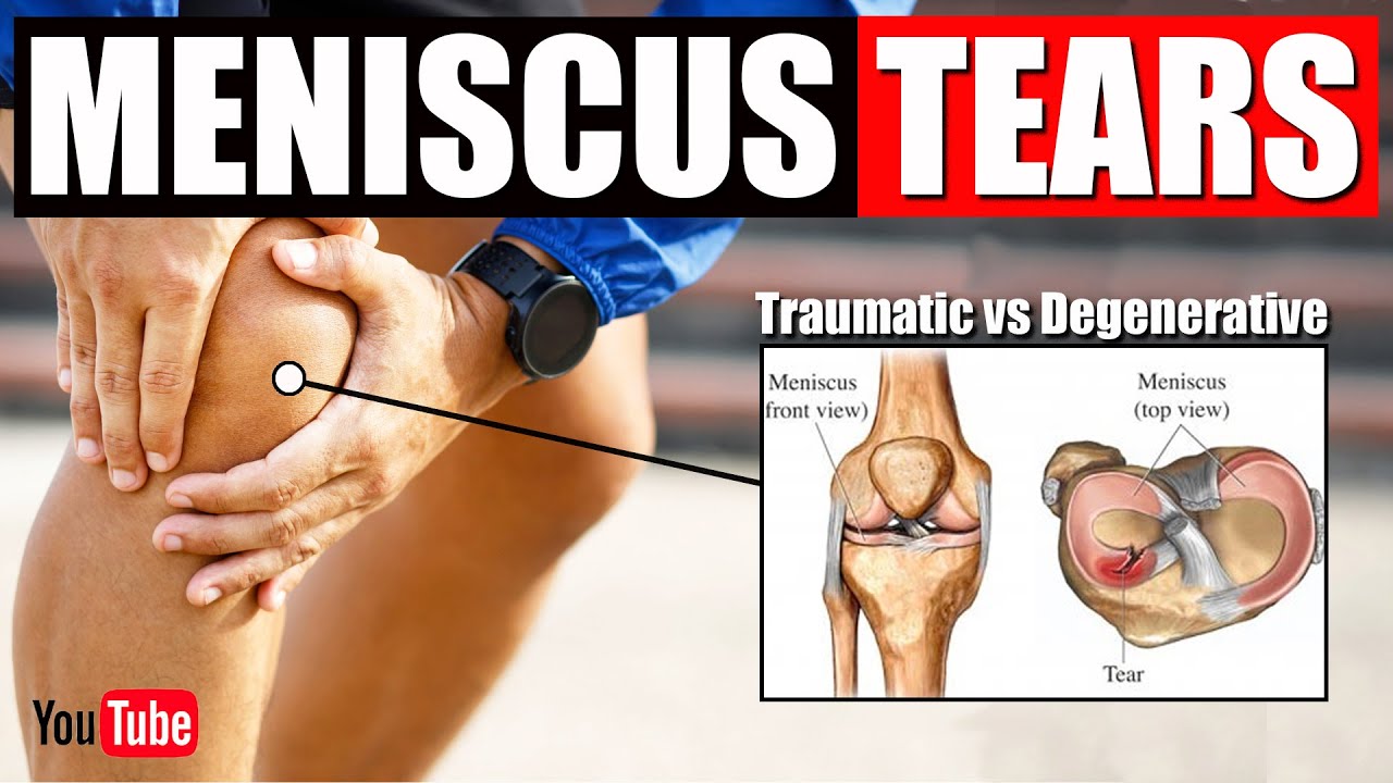 How to FIX Meniscus Tears..Best Stretches & Exercises for Knee Pain ...