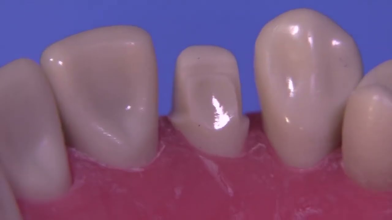 Porselen Lamina Veneer 5- Süper Veneerler