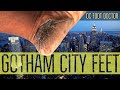 Gotham City Feet: Calluses, Fissures, and Lichenification