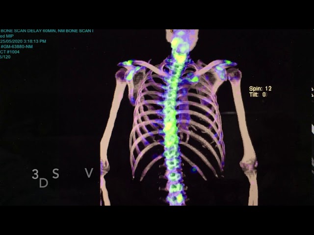 Bone scan: What does it show?