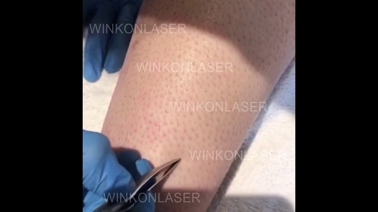 DL900 diode laser feedback