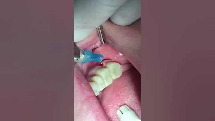 Sneak Peek of the TuttleNumbNow technique