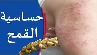 حساسية القمح | علاج أعراض وأسباب الحساسية من القمح ومنتوجات القمح