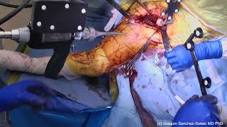 Robotic Assisted Reverse Arthroplasty Using the Stryker Mako Robotic System