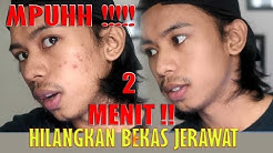 INSTAN HILANGKAN BEKAS JERAWAT  - Duration: 7:56. 