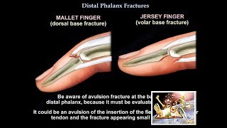 Distal Phalanx Fractures - Everything You Need To Know - Dr. Nabil Ebraheim