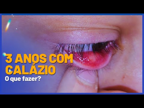 Calázio e hordéolo (terçol): Causas Sintomas e Tratamentos – EYECOLORS –  Vison Care