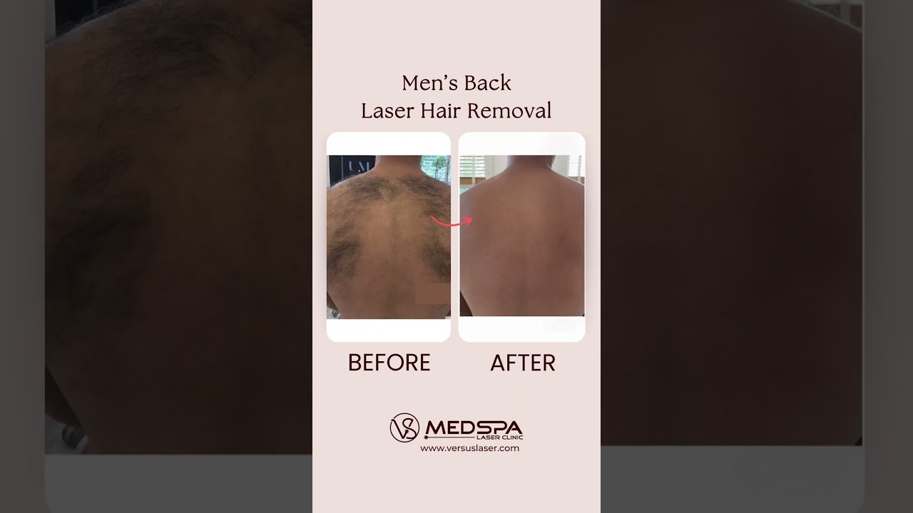 Male back laser hair removal in Toronto