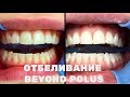 Отбеливание зубов BEYOND Polus | Как проходит процедура
