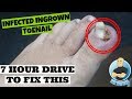 Extreme Infected Ingrown Toenail Removed Permanently in 20 Minutes!