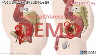[시연용] c0287aako_[대한비뇨의학회] 근치적 방광절제술 및 신방광조성술 안내 (동의서용)