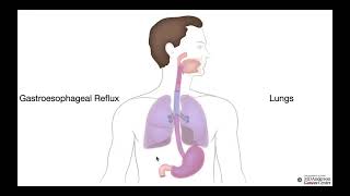 1475-2a Lesson - Esophagus-GERD
