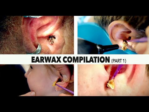 MASSIVE EARWAX REMOVAL COMPILATION (Part 1) | Dr. Paul