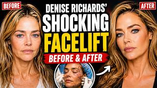 Denise Richards Finally Got the Facelift She Swore She’d Never Get