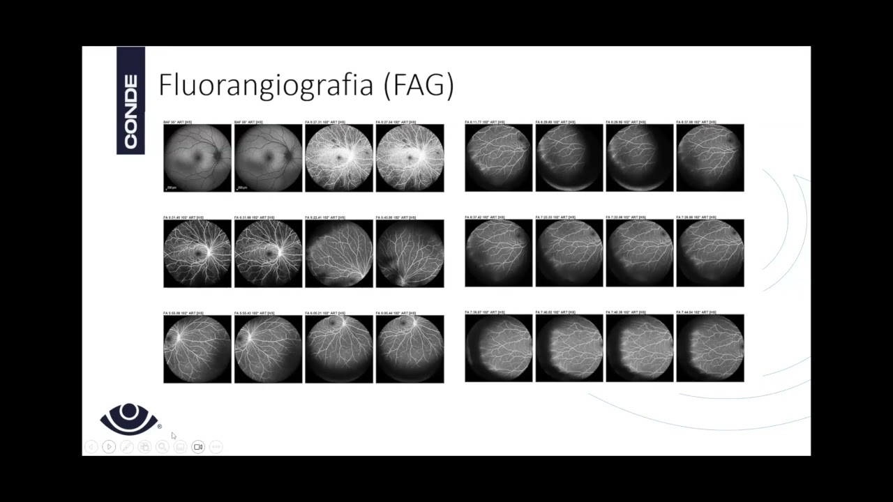 Caso clínico 4 de Uveítis infecciosas