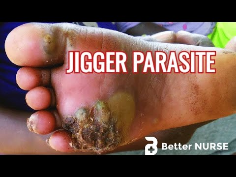 JIGGER PARASITE