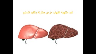 Hepatitis/ تعرف على أنواع التهاب الكبد الفيروسي و طرق انتشاره وهل هناك لقاح أو علاج