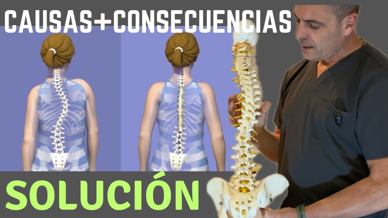 Tienes ESCOLIOSIS? Te explico  que te lo PROVOCA y la SOLUCIÓN 
