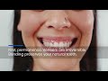 Veneers vs Bonding: 3 Facts You Must Know for Your Smile