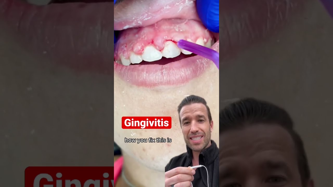 Inflamed Gums After Braces Shorts