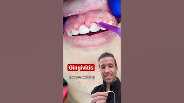 Inflamed gums after braces #shorts