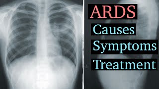 Acute Respiratory Distress Syndrome (ARDS): A Deadly Complication Explained