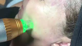 Video 4: 81/49/25 Needles Fractional RF Micro Needling Machine 25/49/81 Pins NIW Surgicals