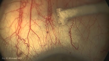 Microinvasive Glaucoma Surgery: Normal Aqueous Veins and Focal Blood Reflux AHMED