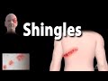 Shingles: Pathophysiology, Symptoms, 3 stages of Infection, Complications, Management, Animation.