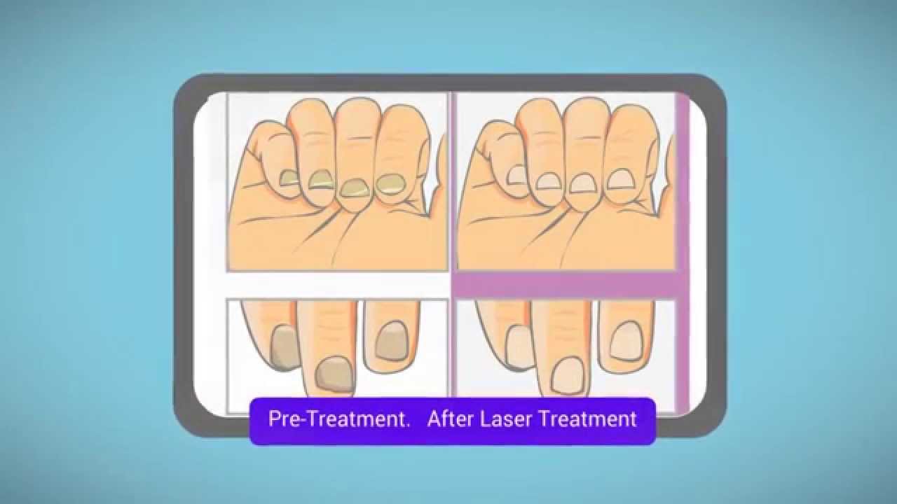 Laser Toenail Fungus Treatment London YouTube