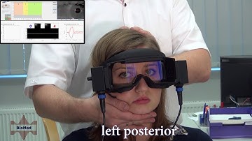 vHIT testing the anterior and posterior SCC