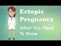 Ectopic Pregnancy - What You Need To Know