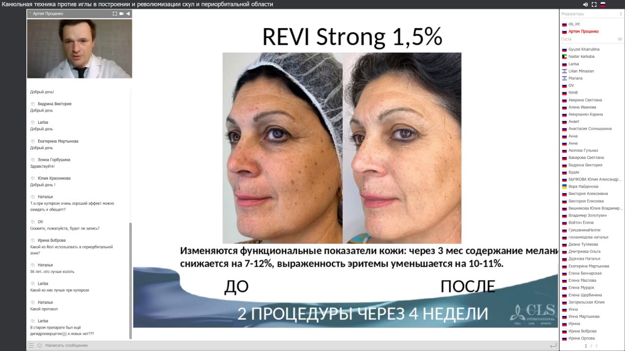 Канюльная техника против иглы в построении и революмизации скул и периорбитальной области