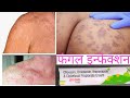 Fungal Infection || फंगल इन्फेक्शन का रामबाण इलाज |