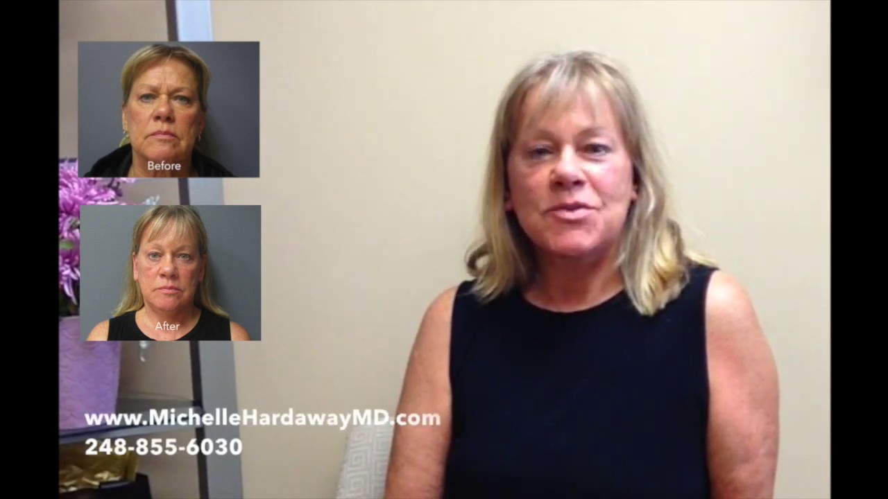 Face Cosmetic Surgery Browlift With Face and Neck Lift | Michigan Plastic Surgeon Michelle Hardaway