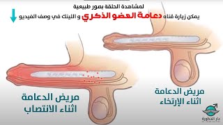 كيف يحدث الانتصاب بعد عملية دعامة العضو الذكري