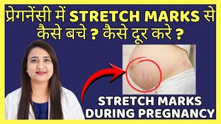 परगनस म Stretch Marks स कस बच ? कस दर कर ? Stretch Marks During Pregnancy