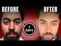 Pimples hatane ka sabse tez tareeka | Remove acne in 7 days