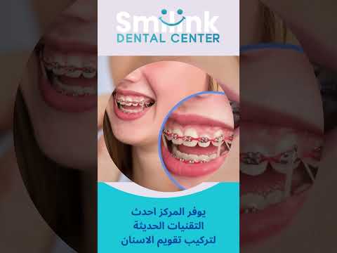 سعر تقويم الأسنان الفك العلوي فقط