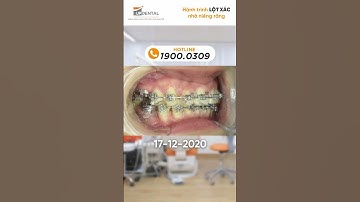Hành trình LỘT XÁC nhờ niềng răng của Hồng Nhung