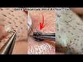 “This Ingrown Hair Extraction Is Surprisingly Satisfying | Derm Reacts”