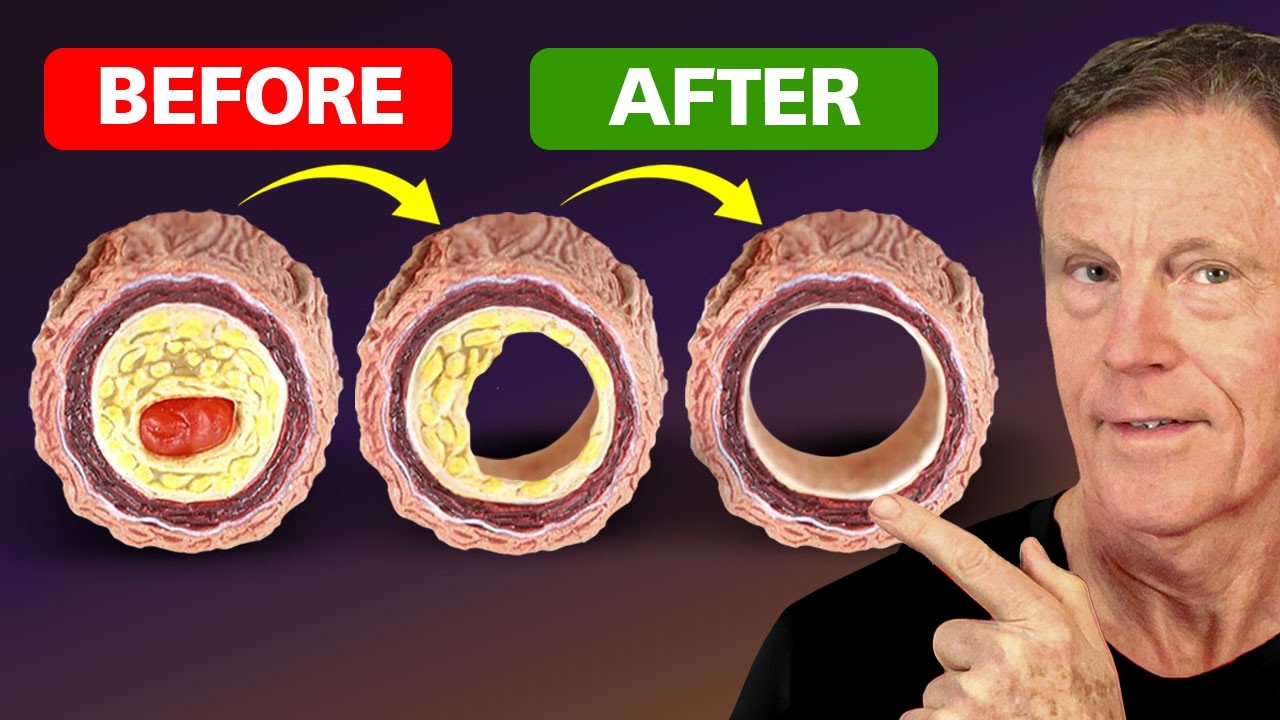 How to Reverse Plaque — 20 Years of Knowledge in One Video