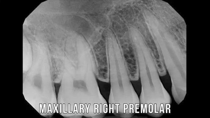 ☢️ FMX Dental X-ray Guide (Are They Safe?)