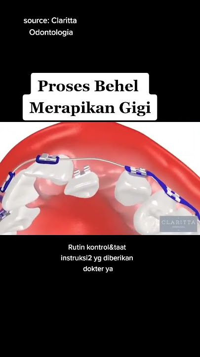 Gimana sih proses behel merapikan gigi? mimin kasih intip 🤗Source:https://vt.tiktok.com/ZS89mCCaA/