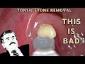 It gets bad  tonsil stone removal  aim 19