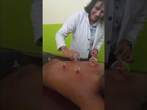 Cupping Therapy 