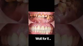 Full mouth rehab #fmr #smilemakeover #dentist #shorts