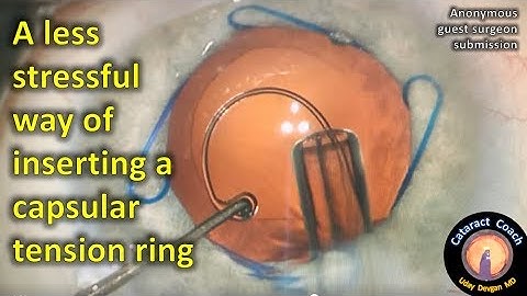 CTR insertion technique with less capsular stress in cataract surgery