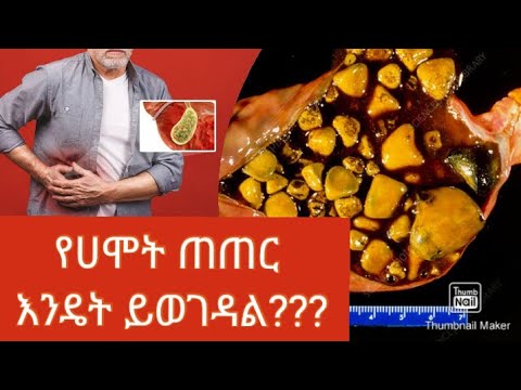 ቪዲዮ: የሐሞት ጠጠርን ለመፍታት 3 መንገዶች